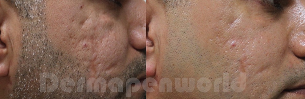 Efekty DERMAPEN 4.0