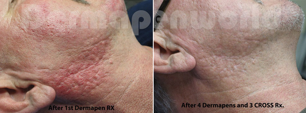Efekty DERMAPEN 4.0