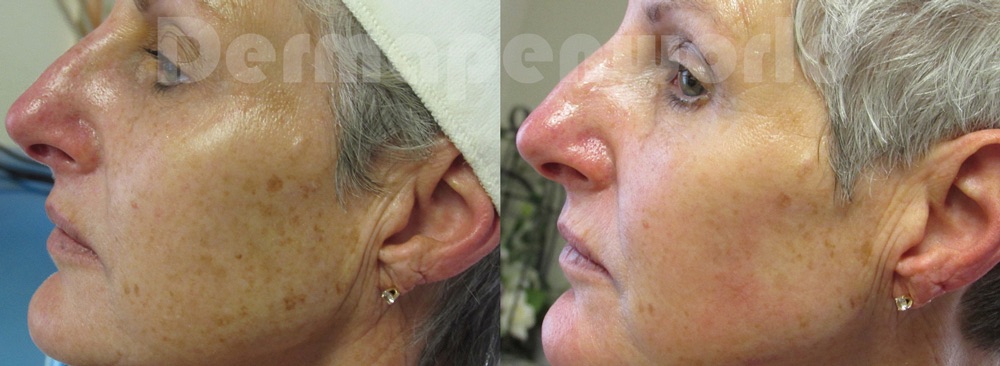 Efekty DERMAPEN 4.0